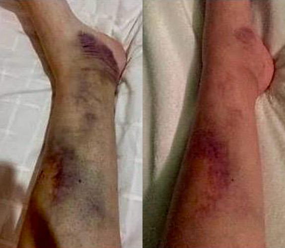 Contuzie în urma unei căzături 1 ședință de tratament